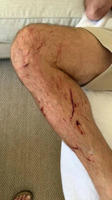  突发焦虑：从希勒骑行摔伤看运动安全防范机制 健康养生